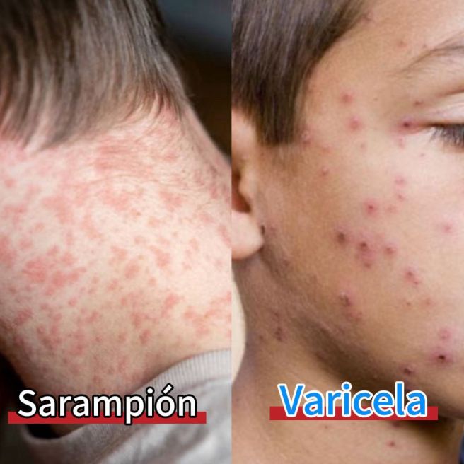 REFUERZAN CAMPAÑA INFORMATIVA SOBRE SARAMPIÓN Y&nbsp;VIRUELA